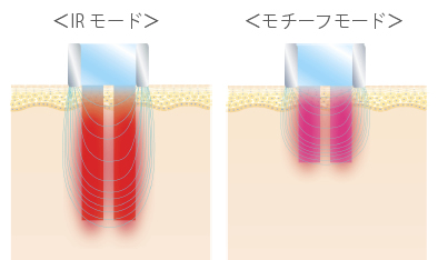 【画像】治療の幅が広がる2つの照射モード